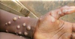 Rare case of monkeypox found in Texas resident who had traveled internationally