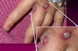 There Is Now A Confirmed Case Of Monkeypox In Texas – Will This Become Another Pandemic?