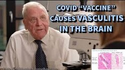 Dr. Burkhardt Revealed Vasculitis In Brain of Almost All Autopsy Reports After Covid 