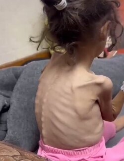 Malnutrition and dehydration! Starvation!