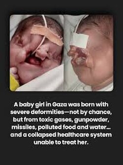 Gaza baby Hekma Nofal, 21 days old, was born with severe and complex facial deformities caused by her mother’s exposure to toxic gases, gunpowder, Israeli missiles, contaminated food and water.