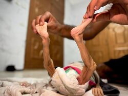 Director General of the Ministry of Health in Gaza: 40,000 infants and 250,000 children are at risk of slow death due to famine and malnutrition.